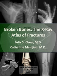 Broken Bones: The X-Ray Atlas of Fractures - Felix Chew