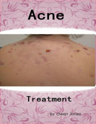 Acne Treatment Owen Jones Author